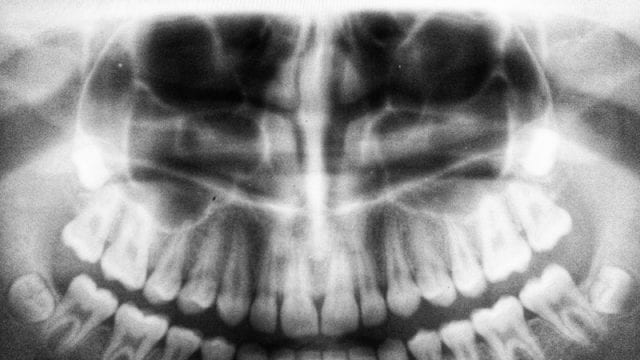 Root Canal, reno nv dentist