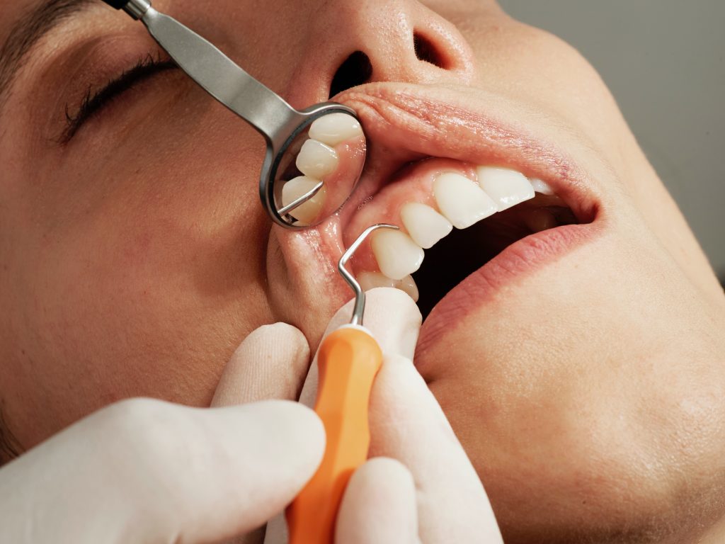 A person receiving a teeth cleaning in Reno