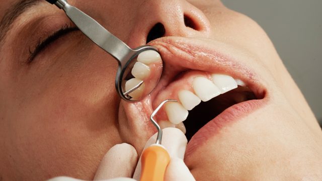 A person receiving a teeth cleaning in Reno